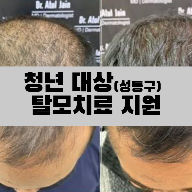  성동구 서울시, 39세 청년 대상 탈모치료 지원 프로그램 신청하기