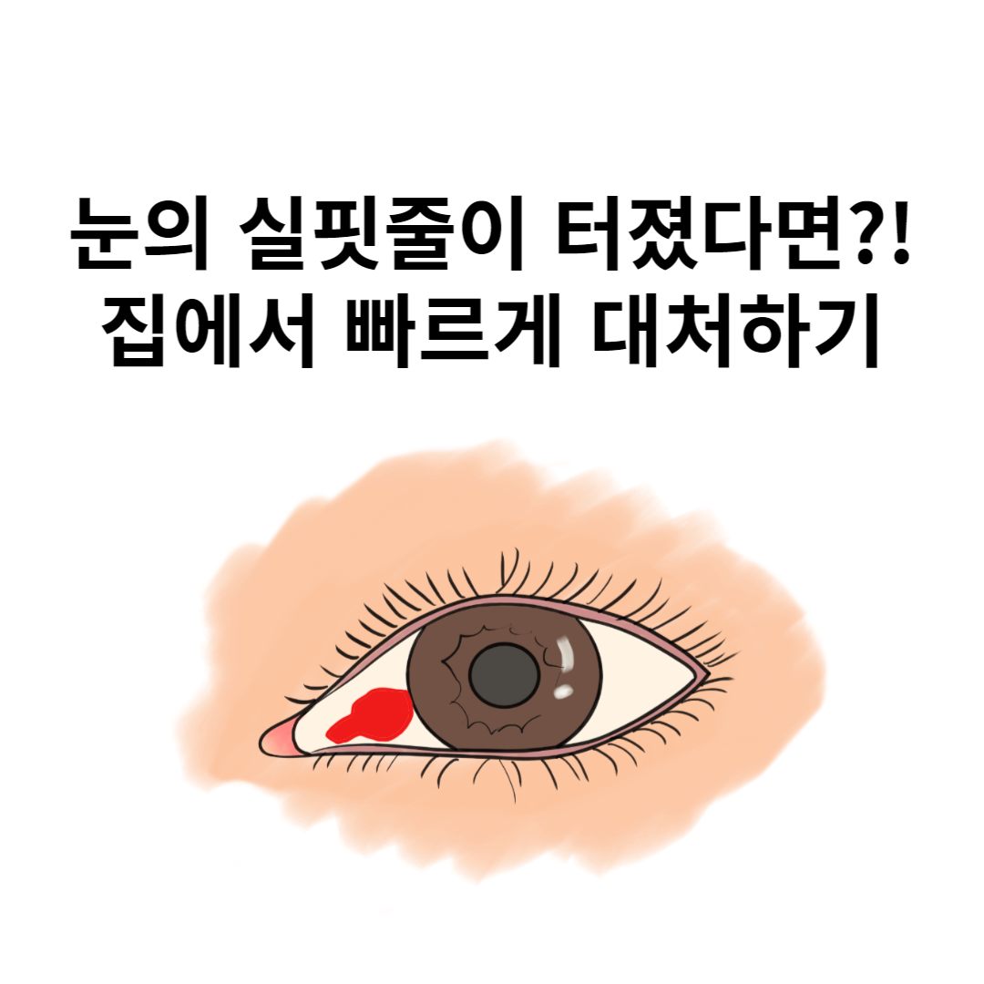  눈에서 실핏줄이 터졌다면?! 집에서 빠르게 대처하는 방법!