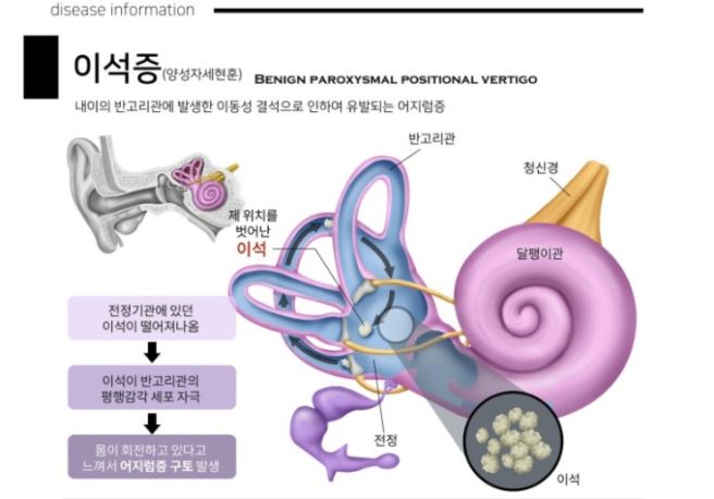 이석증 원인