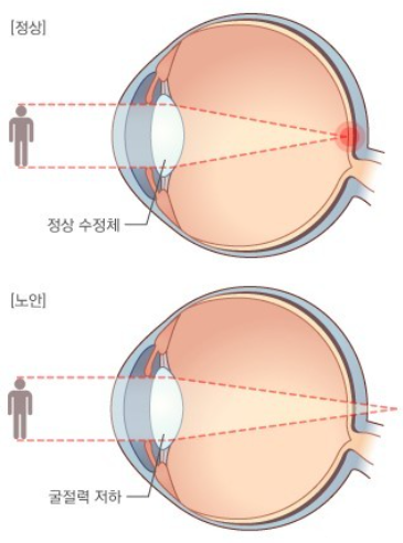 노안백내장