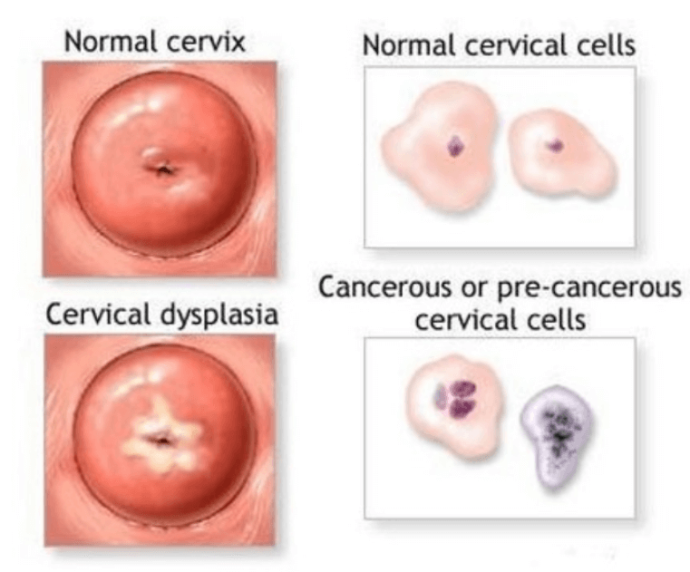 자궁경부암 예방접종 가격 자궁경부암 무료접종 대상