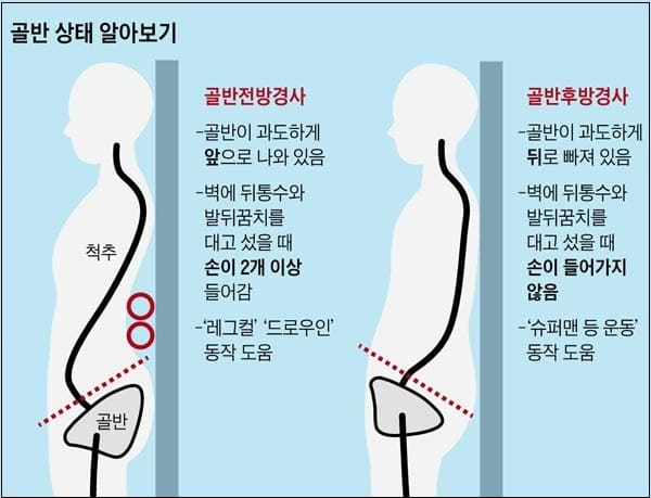 뱃살 없는데&#44; 배 나와 보이는 경우