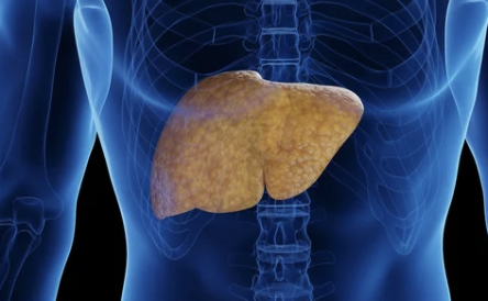 Fatty Liver Disease