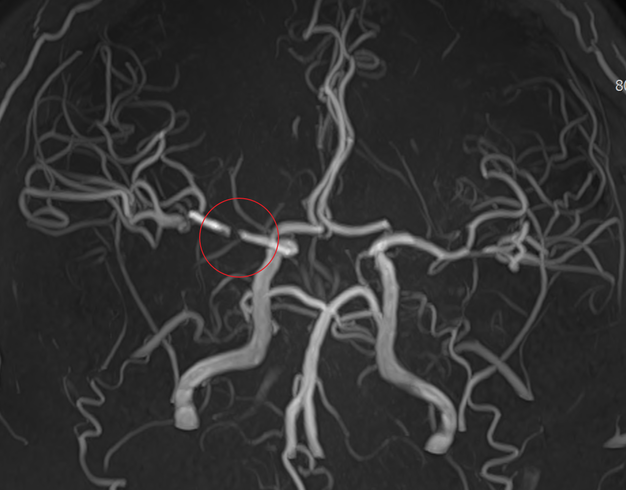 뇌혈관MRA-중뇌동맥협착