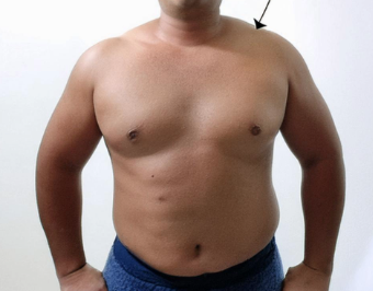 남자 체지방률 평균 30 25 20 22 23 18 17 15 10 계산방법 실제사례 - 남자 체지방률의 변천사: 준호의 이야기 - 3단계: 중반의 도전 남자 체지방률 평균 30 25 20 22 23 18 17 15 10 계산방법 실제사례 - 남자 체지방률의 변천사: 준호의 이야기 - 3단계: 중반의 도전