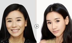 안면윤곽 양악 연예인 전 후 돌이킬 수 없는 부작용 안면윤곽 양악 연예인 전 후 돌이킬 수 없는 부작용