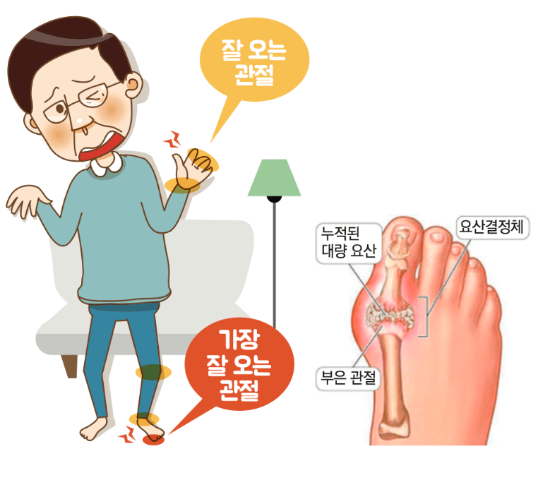 통풍 원인