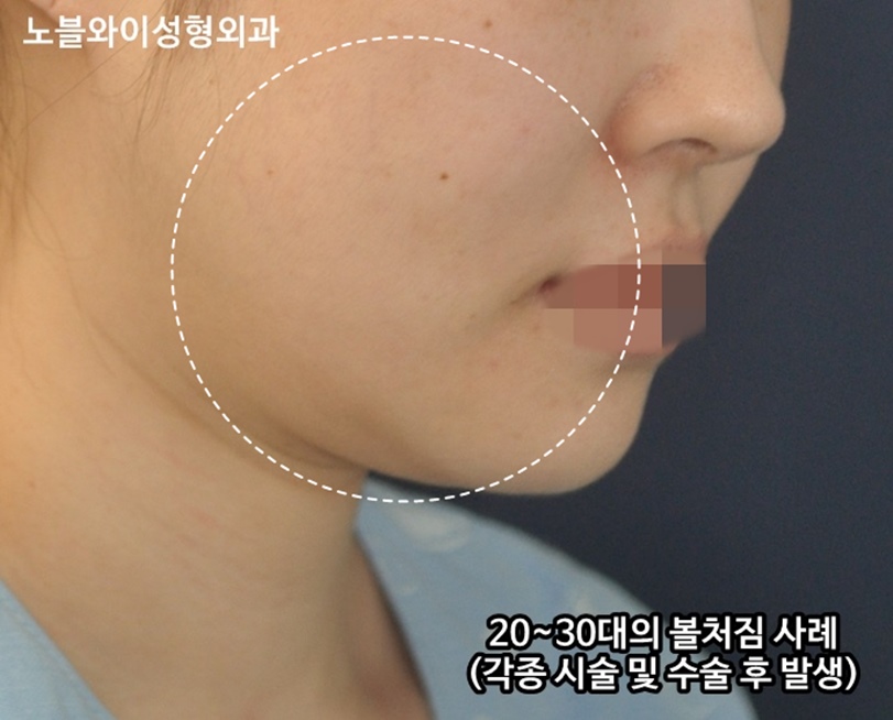  안면거상 후기 5년 넘은 거 발견