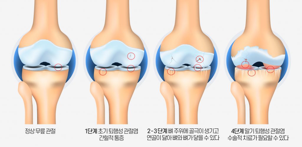 관절염 진행단계