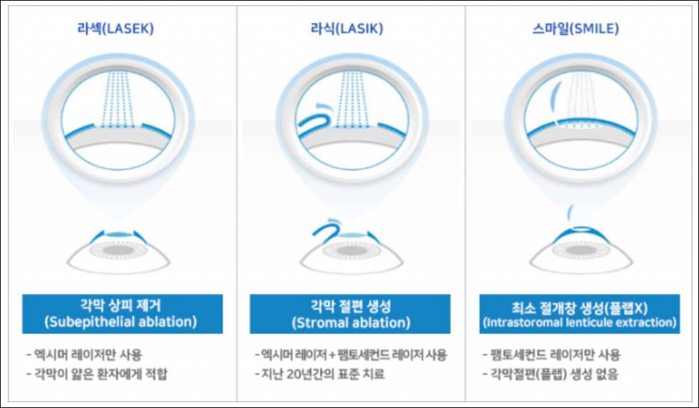 라식 라섹 스마일 렌즈삽입술 수술과정 비용 가격 차이 후관리 부작용 통증 회복기간 실비보험 지원금 후기