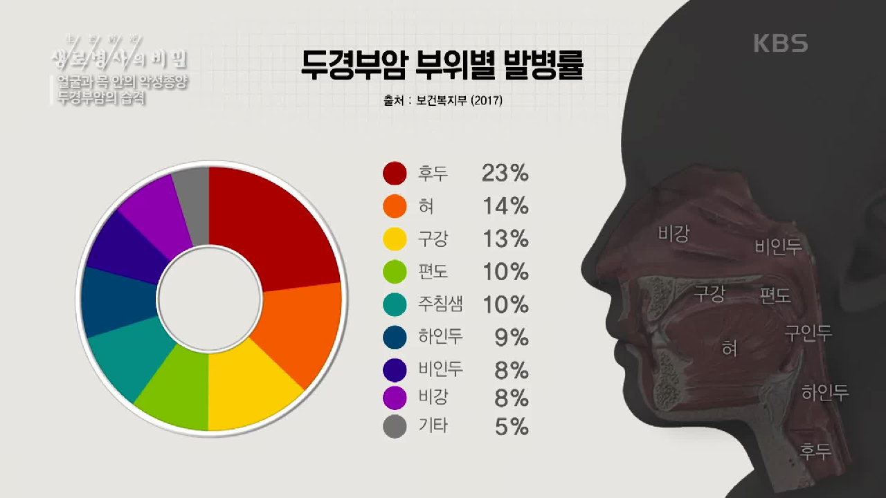  생로병사의 비밀 개그맨 배영만 후두암 치료 완치법 두경부암 치료 완치 극복법 #인두암 #설암 #편도암 #얼굴목악성종양 #혹제거절제술 #두경부암 인유두종바이러스 #두경부암 원인