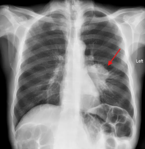 lung squamous cell carcinoma