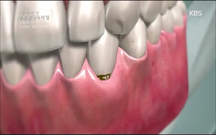 [670회] 생로병사의 비밀 - KBS670회] 생로병사의 비밀.ts_20220505_143212.277.jpg