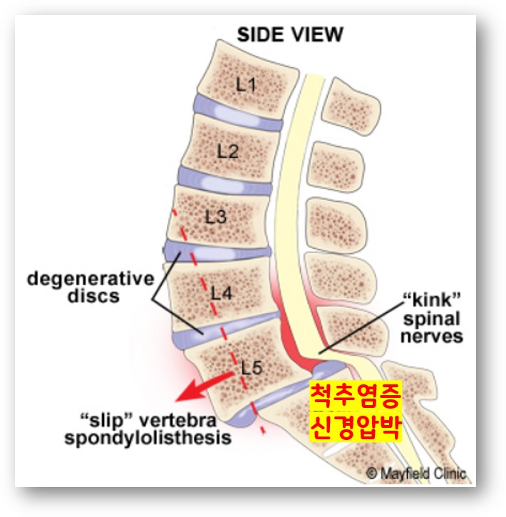 척추 전방전위증의 증상