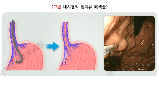 정맥류 폐색술