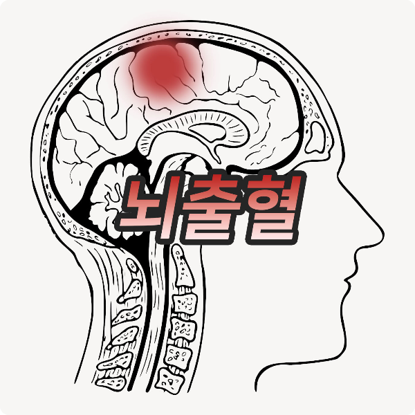  얼른 오셔서 뇌출혈 전조증상 체크리스트 확인해보세요!