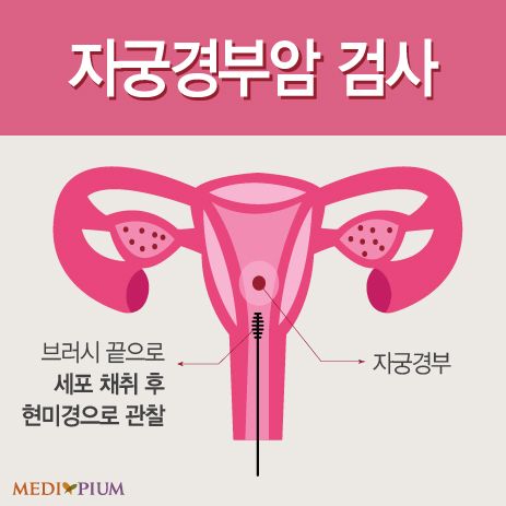 자궁암 초기증상