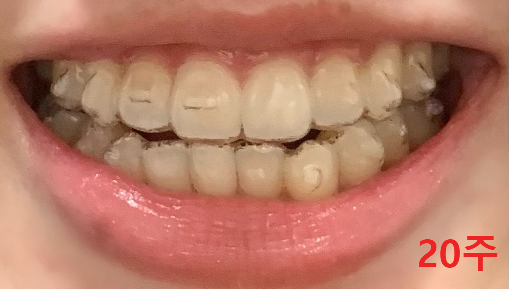 인비절라인-착용-20주-사진