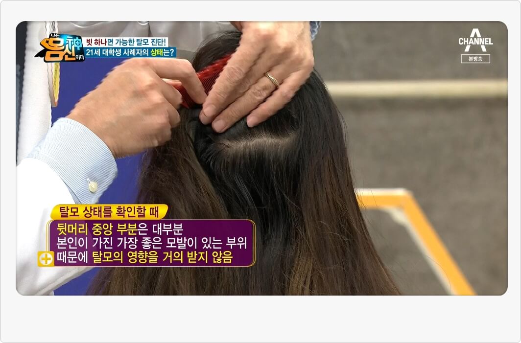 탈모상태체크