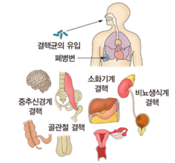 잠복결핵검사