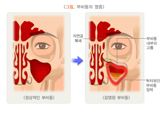  부비동염(코부비동염)