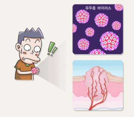 물사마귀 없애는 방법: 이렇게 없애봐요!