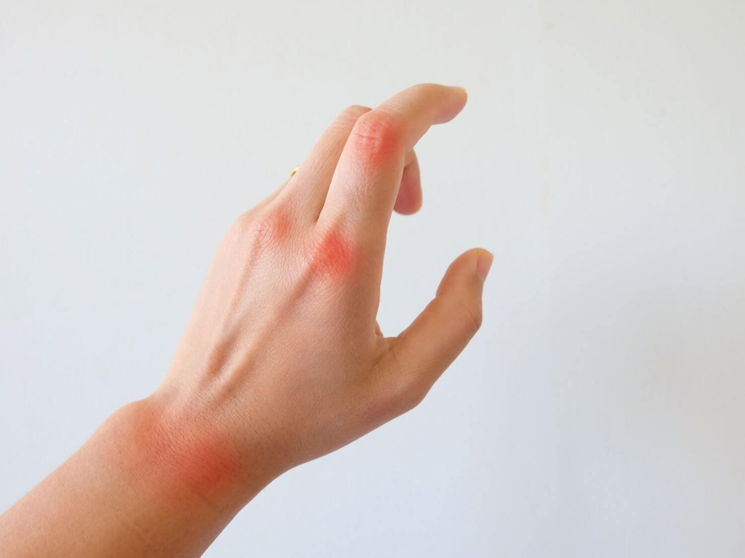 손가락 관절염 초기증상