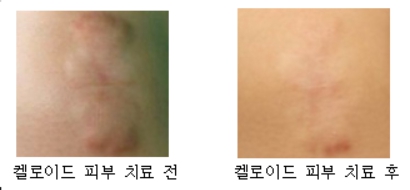 켈로이드 피부 치료 전(좌측)과 후(우측) 이미지 사진 입니다.