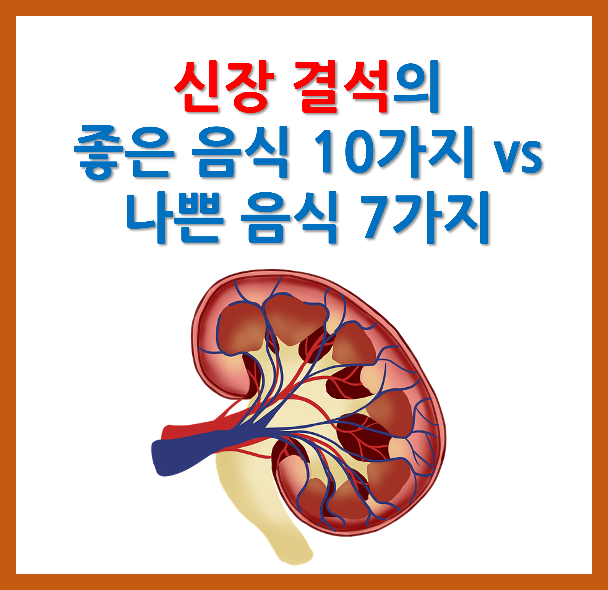 신장 결석에 좋은 음식, 나쁜 음식