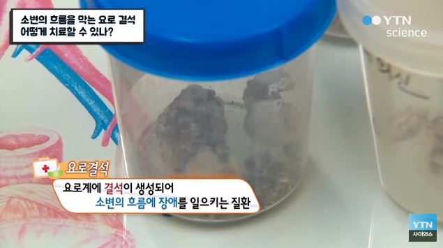  요로결석 피해야 하는 음식..요로결석에 좋은 음식