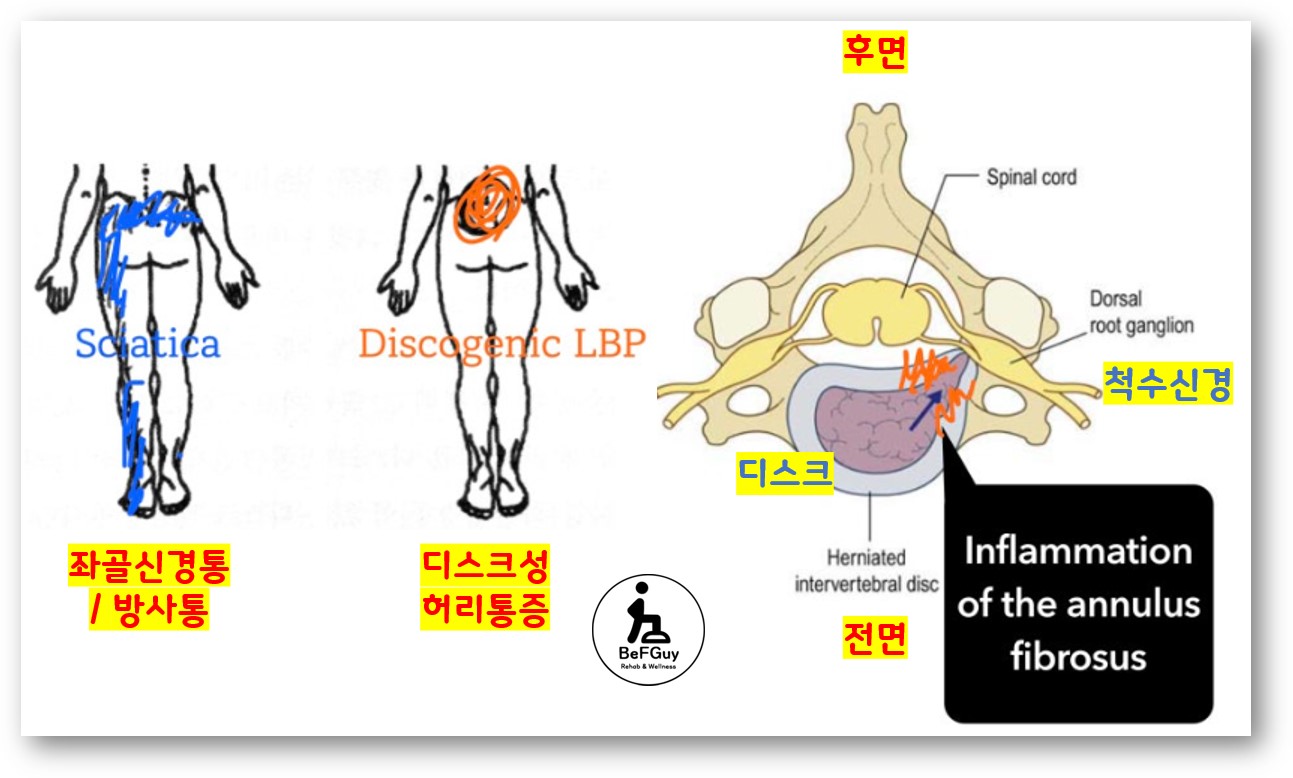 디스크성 허리통증과 좌골신경통