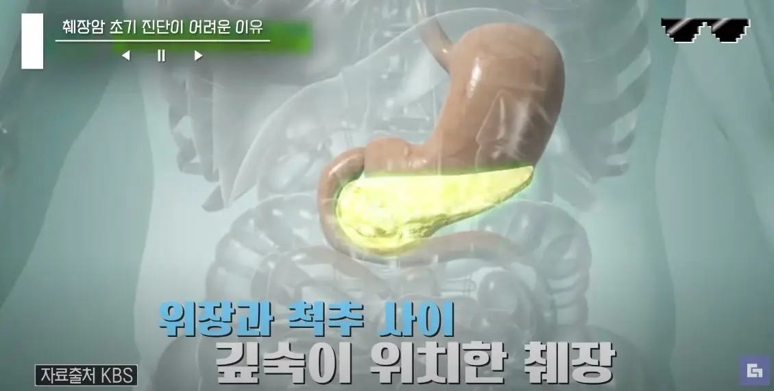  췌장암 발병률 1위 바로 B형 남성으로 밝혀졌습니다