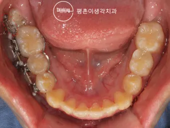 어금니 칫솔 사용법 선택방법 실사용 후기_7