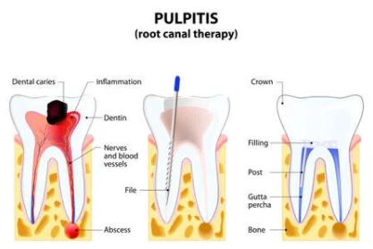 치수염-치과질환