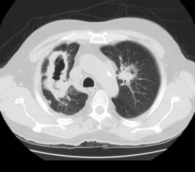 Wegener granulomatosis multiple cavitary lesions