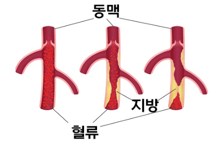 고지혈증 관련사진