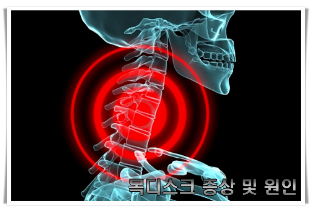 목디스크 증상