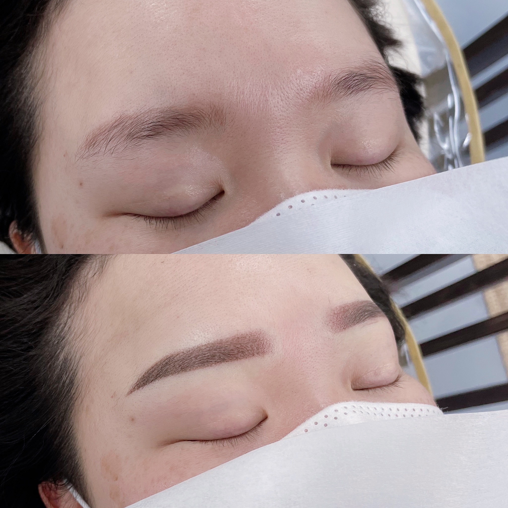  천안눈썹문신제거: 붉은잔흔, 잿빛잔흔 깔끔하게 지우자