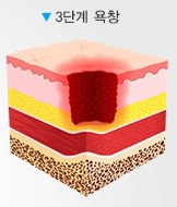 욕창3단계