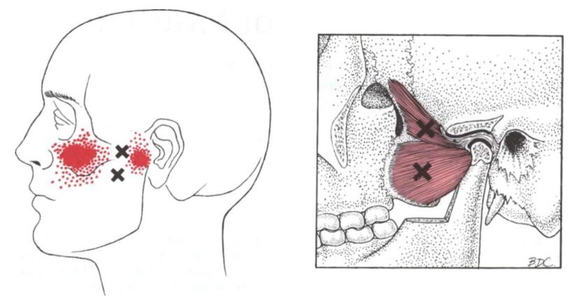 외측익상근의 연관통부위를 나타낸 그림&#44; 관골과 귀 사이에 외측익상근의 상부섬유 한곳&#44; 하부섬유 한곳에 통증유발점이 있고 뺨부위와 귀 앞쪽에 통증이 발생하는 그림