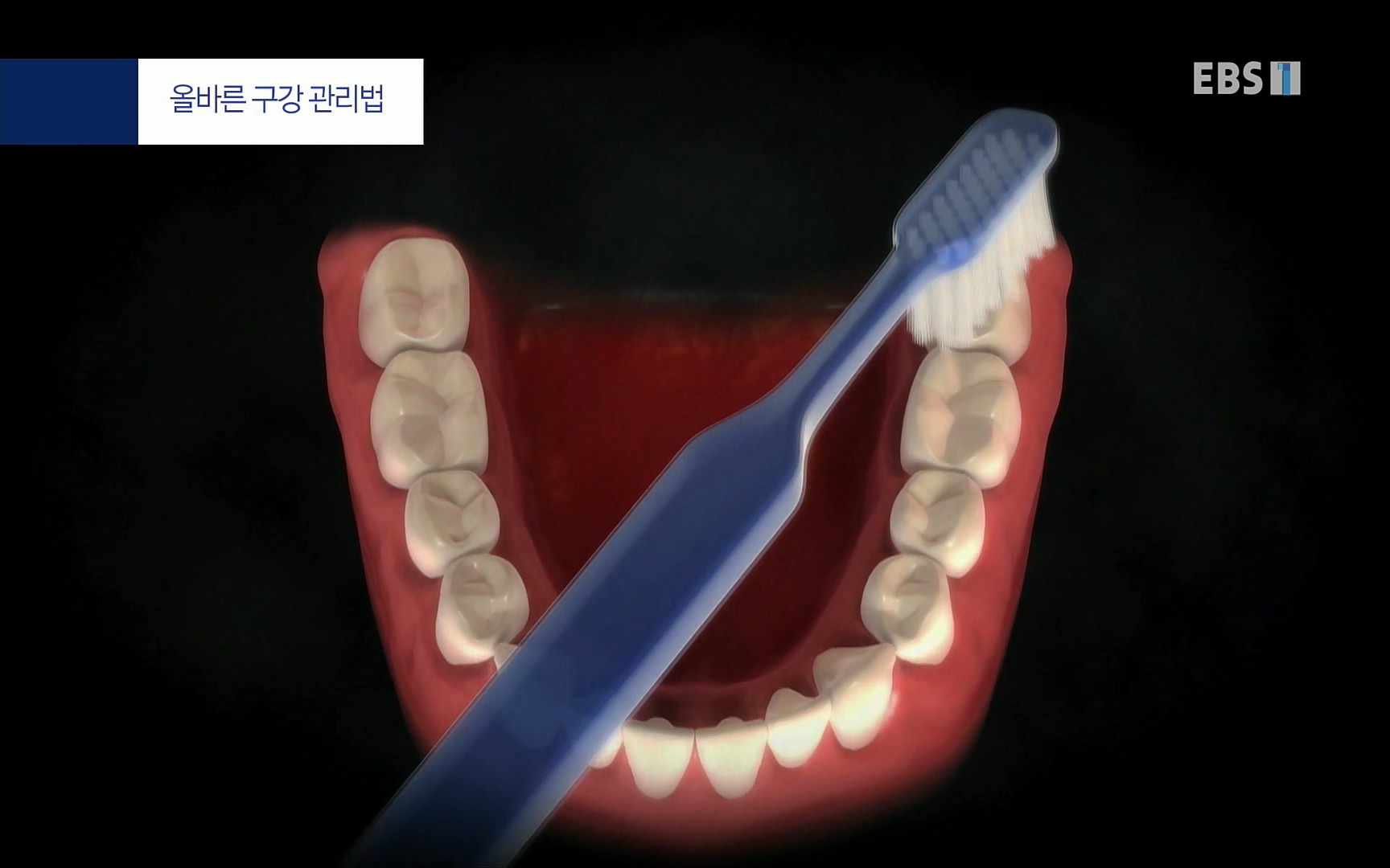 EBS 명의 헬스케어 - TV - 교육의 중심 EBS치주염이 코로나로 소홀해진 구강관리가 치아를 더 망가트리고 위험하게 만들며, 증상이 없기 때문에 특히 더 조심하고 치은염 단계에서 진행되지 않도록 예방해야한다 정의원 교수님과 치_20220505_151724.026.jpg