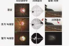 녹내장 증상 및 치료방법