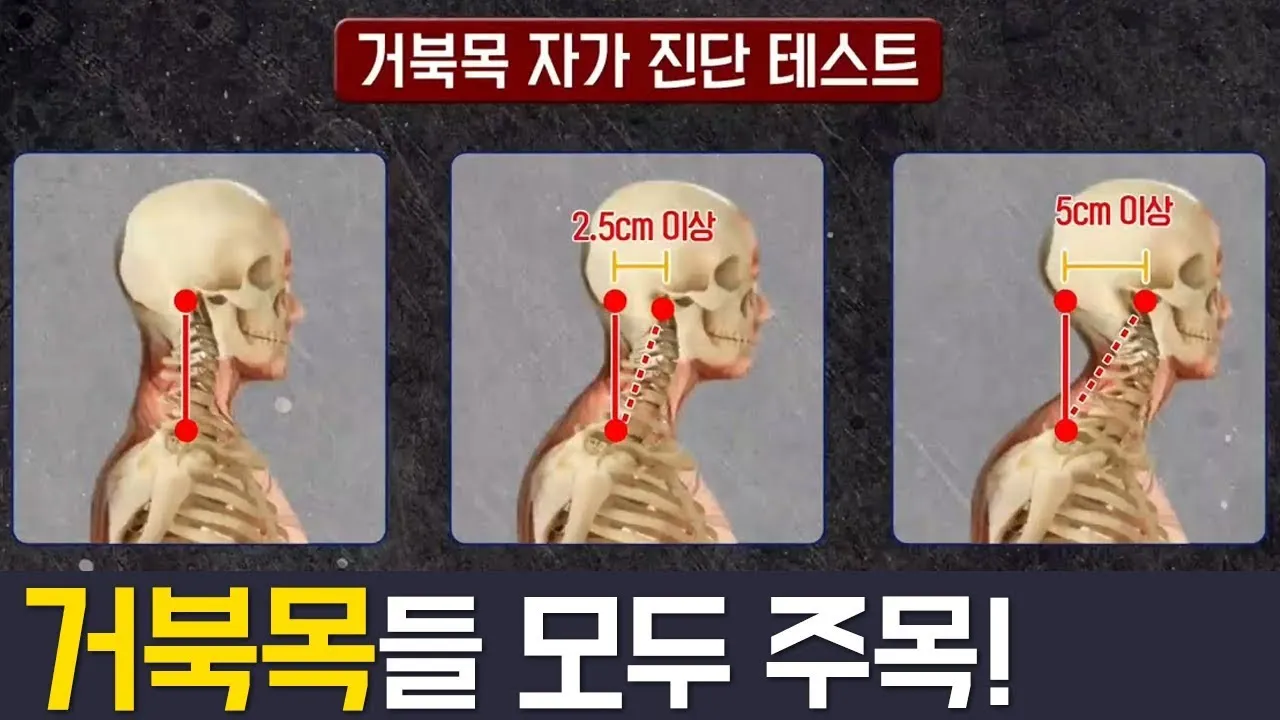 거북목 증상 치료법 스트레칭_4
