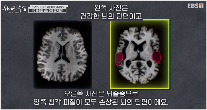 &quot;alt&quot;:&quot;뇌의 단면 스캔 사진&quot;