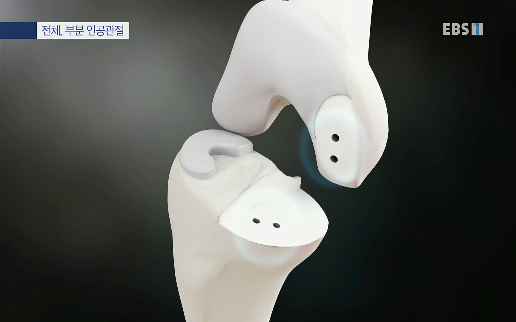 EBS 명의 헬스케어 - TV - 교육의 중심 EBS무릎 건강 프로젝트 2부 새 무릎으로 사는 법 .mp4_20220726_202337.557.jpg