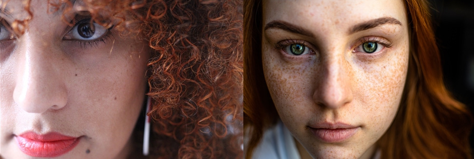 왼쪽 사진은 볼 쪽에 기미가 있는 여자 사진이고&#44; 오른쪽 사진은 얼굴 전체에 주근깨가 뒤덮여 있는 여자 사진