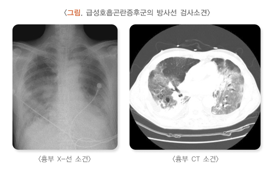  급성호흡곤란증후군