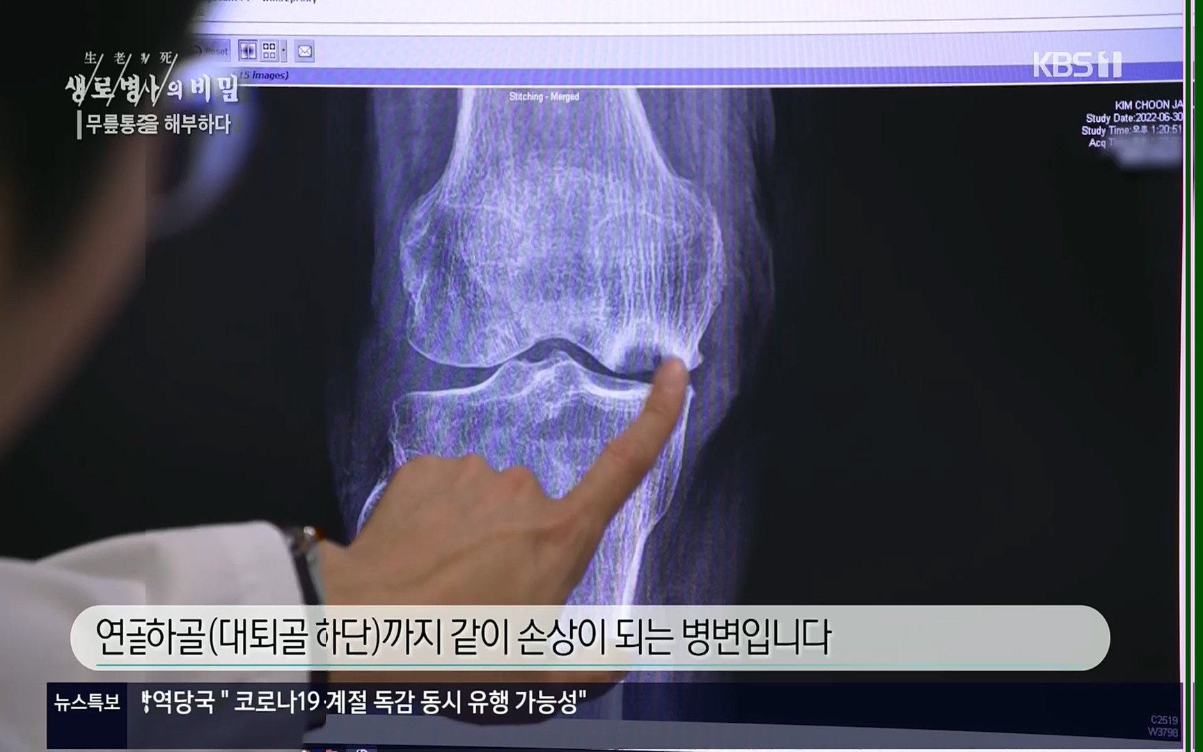 생로병사의 비밀.E834.220907p.H264-F1RST.mp4_20220908_210415.858.jpg