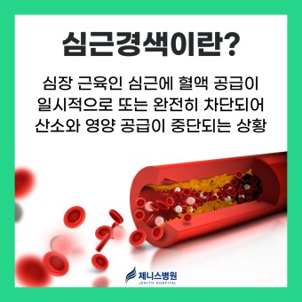 심근경색 초기증상