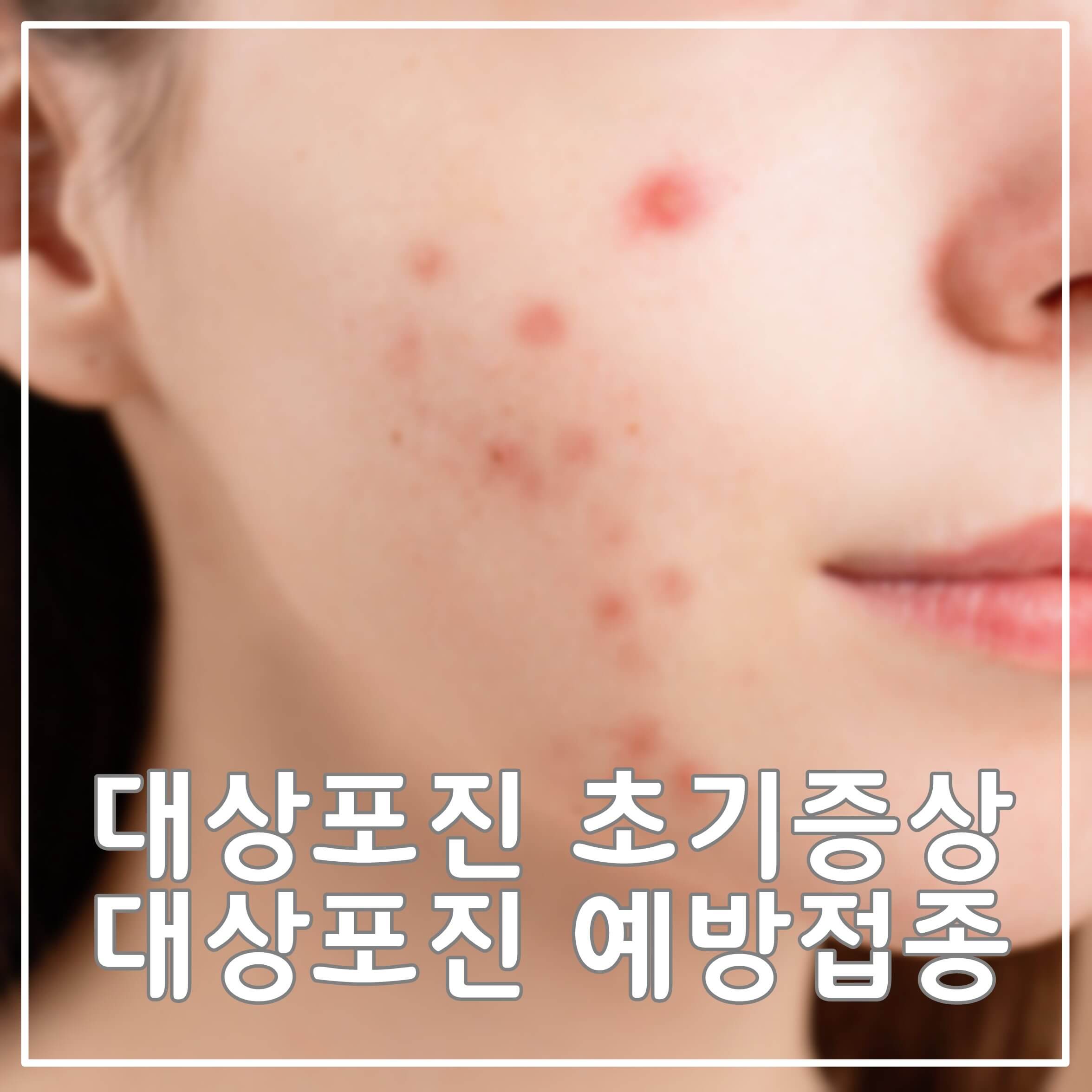  대상포진 초기증상과 대상포진 예방접종